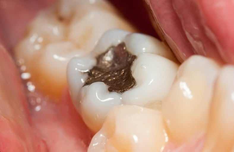 Amalgam Removal and White Fillings