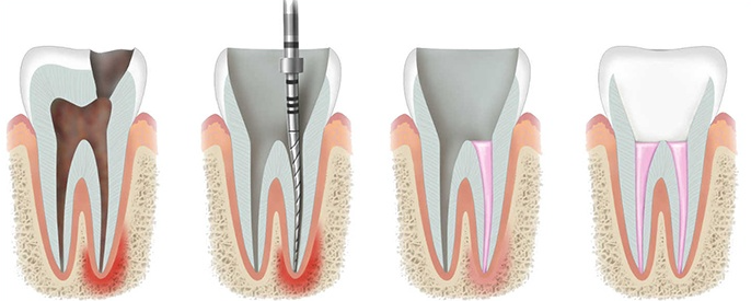 Root Canal Treatment